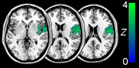 mriCroN(医学影像分析软件)